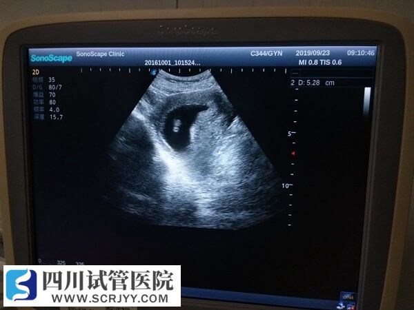 移植囊胚生男生女概率一致